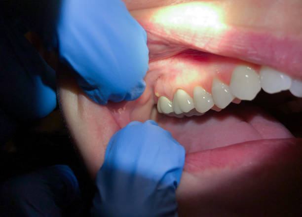 Best Emergency Root Canal Treatment in Wilson, WY